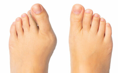 Krzywe palce u nóg – przyczyny, ćwiczenia i leczenie