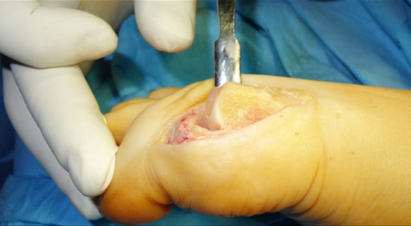 Implant Cartiva